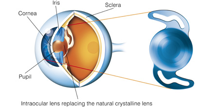 Lens In The Eye