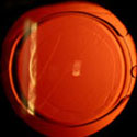 C-flex® lens with 360° enhanced edge at six months post operative showing excellent barrier effect to the centripetal epithelial growth