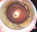 The implanted C-flex® (courtesy of Dr James A Davison)